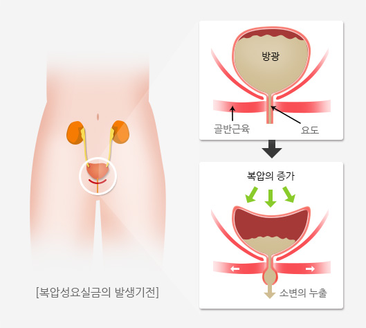 복압성 요실금 사진