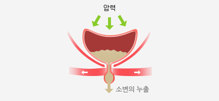 혼합성 요실금