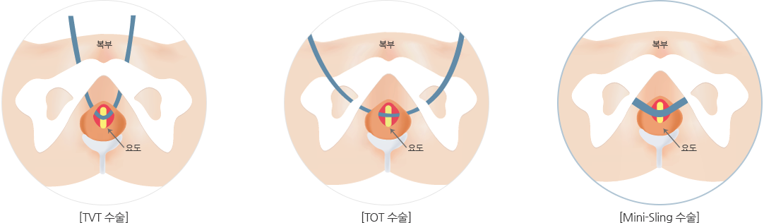 로앤산부인과 Mini-Sling 요실금 수술 